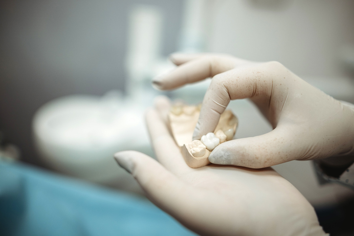 Cómo cuidar un implante dental para que dure toda la vida